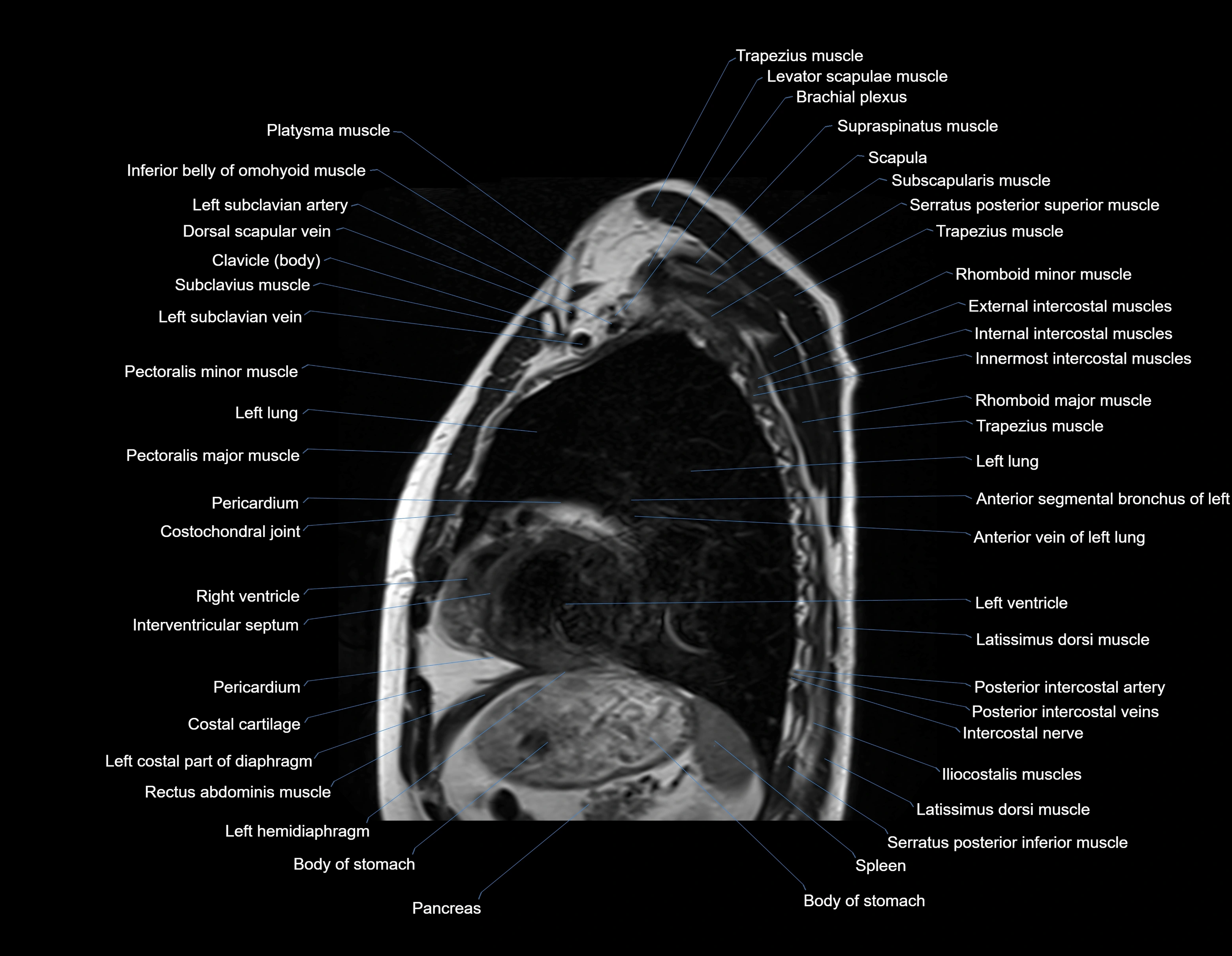 MRI chest (thorax) sagittal labelled cross sectional anatomy 3T radiology image-img-00001-00027.webp